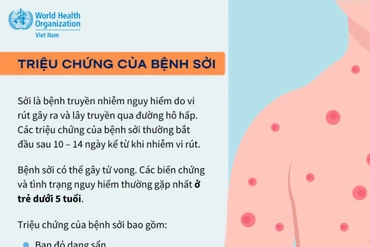 WHO khuyến cáo bảo đảm miễn dịch đối với bệnh sởi trong dịp Tết