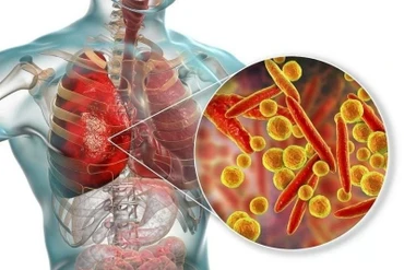 Bộ Y tế thông tin về các ca mắc bệnh chưa rõ nguyên nhân tại Nga